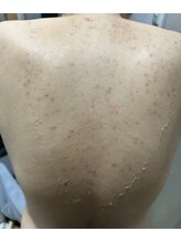 ビエストラ(Biestora)/ハーブピーリング4回目のお客様