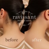 ラヴィソン(ravissant)