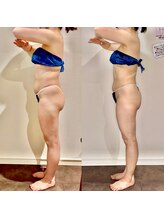 カルナ(CARNA)/【痩身】セルライトゼロ2