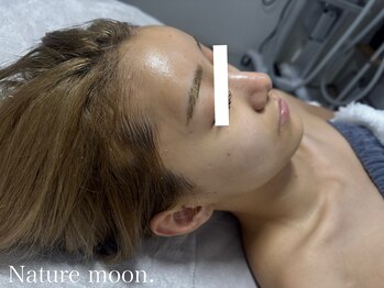 ナチュールムーン(Nature moon.)/ハーブピーリング　after
