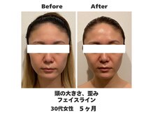 ラナン パラフューズ(Ranun's PARAFUSE.)/フェイスラインも激変♪