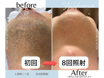 ユシェリア(Yucheria)/ヒゲ脱毛経過