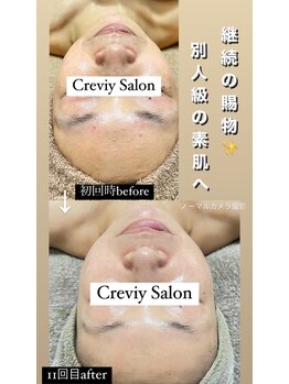 クレヴィー(Creviy)/月イチ陶肌トリートメント11回目