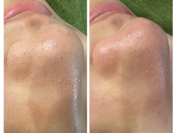 メディカルサンテロッソ 福岡店(MEDICAL SANTEROSSO)/韓国式3D毛穴洗浄