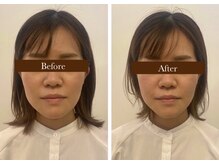 クレファ(CREFA)の雰囲気（メイクを落とさず1度で変化実感！今までにない新感覚小顔リフト）