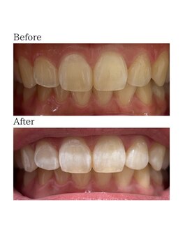 ノーブル 上土店(Noble)/ホワイトニングBeforeAfter