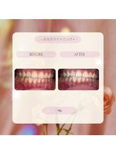 プラスビー 2号店(+b)/ホワイトニングビフォーアフター