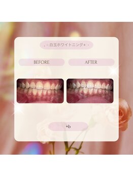 プラスビー 2号店(+b)/ホワイトニングビフォーアフター