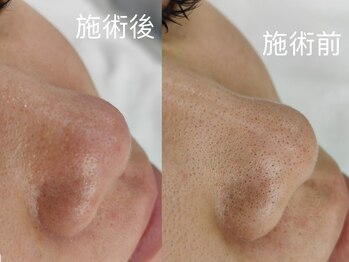 ルミエール 新宿(Lumierre)/ハーブピーリング+毛穴洗浄