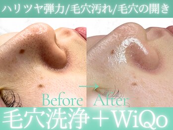 Cスキンケアクリニック 麻布店/ハイドラ+WiQoピーリング