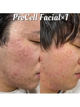 アイスブルー(Ice blue)/プロセル肌質改善トリートメント