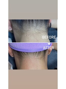 アンヴィオ ギンザ(Anvio Ginza)/うなじ(Mパーツ)ワックス脱毛