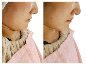 ベリッセ(Belisse)/レモンボトル*フェイスライン