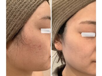 リズ(Liz)/ナークハーブピーリング