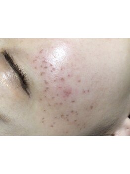 シミしわ改善！予防ケア