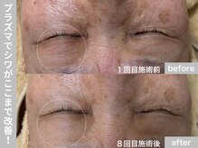 サロン ビュー(salon view)/70代女性〈シワ悩み〉　