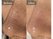 ひびき 京都烏丸御池店/黒ずみ毛穴/角栓除去★毛穴洗浄