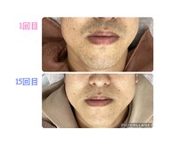 リオンズ 柏駅前店/ヒゲ脱毛８ヶ月ビフォーアフター