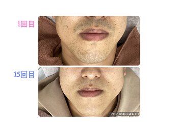 リオンズ 柏駅前店/ヒゲ脱毛8ヶ月ビフォーアフター