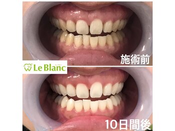 ルブラン 奈良店(Le Blanc)/20回照射！期限無しで！