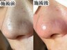 【本気の毛穴改善】毛穴エクストラクション×美肌洗浄で黒ずみ・開きを撃退！
