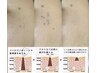 【学割U24】シミケア10分当て放題 ¥3,500