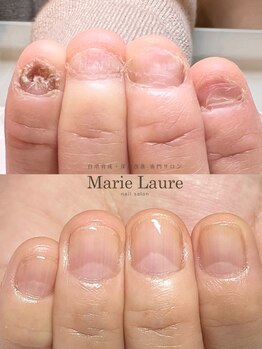 マリーロール 梅田店(Marie Laure)/自爪育成/深爪矯正/ネイルケア