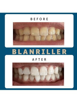 ブランリエ 天王寺阿倍野店(BLANRILLER)/セルフホワイトニング