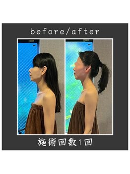 サロン ド ハーモニー美/コルギ♪ エラの改善・小顔