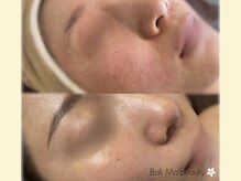 バリマ ビューティー(Bali Ma'beauty)/脱☆毛穴開き/汚れ