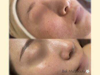 バリマ ビューティー(Bali Ma'beauty)/脱☆毛穴開き/汚れ
