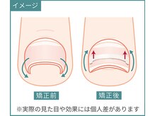 巻き爪研究所 表参道院/1回の矯正で痛みは大幅に軽減