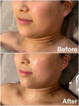 タオ(TAO)/小顔コルギ：記念写真の撮影前に