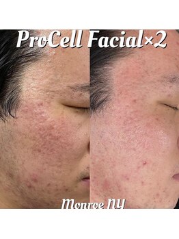 アイスブルー(Ice blue)/プロセル肌質改善トリートメント