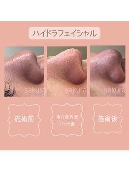 ビューティートータルサロン サクラ 千歳店(SAKURA)/毛穴洗浄☆ハイドロフェイシャル