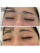 ルミエール(Lumiere)/２０代女性　青クマ乾燥改善