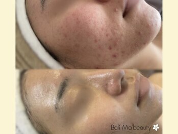 バリマ ビューティー(Bali Ma'beauty)/本格的ニキビケアもサポート◎