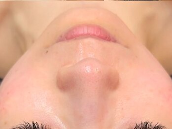 ラトナ(RATNA)の写真/【マイクロニードル導入店☆】セルフケアでは難しいお肌のざらつきやニキビへ徹底アプローチ！