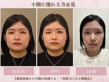 フラン(franc)/大きな顔はむくみだった！