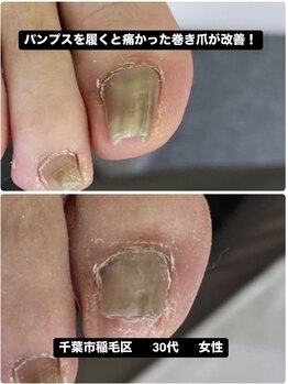 巻き爪の痛みから解放され笑顔