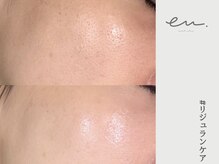 エム(eM.)/リジュランケア１回施術例