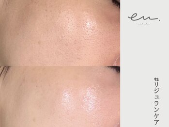 エム(eM.)/リジュランケア1回施術例