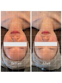 LiNOA./毛穴洗浄×サーマフラクショナル