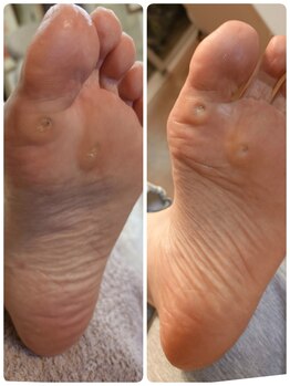 フットスタジオ アルク(FOOT STUDIO ALUK)/【魚の目、タコ】除去 角質ケア
