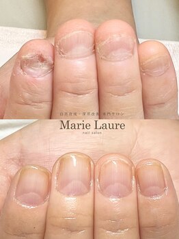 マリーロール 梅田店(Marie Laure)/自爪育成/深爪矯正/ネイルケア