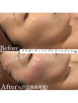 ミエル 神戸店(Miel)/リアボーテタラソトリートメント