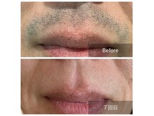 エックス(X)の雰囲気（約２ヵ月半の脱毛効果★ミ）