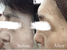 コスメティック雅/【小鼻の黒ずみ改善】