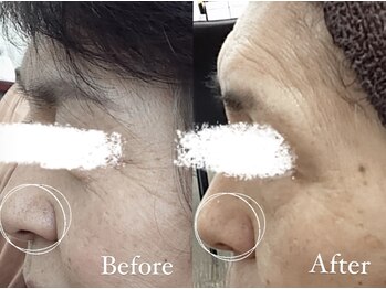 コスメティック雅/【小鼻の黒ずみ改善】