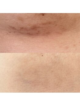 ラ クレール ビューティーサロン(LA CLAIR)/ローマピンク(ボディ)